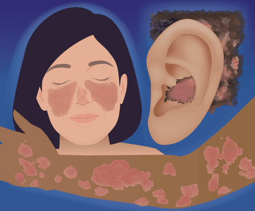 CMEswiper: Swipe to See CLE: Recognition and Diagnosis of Cutaneous Lupus Erythematosus: An Online Activity