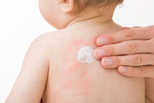 PosterToPractice: Ripple Effect: Targeted Topical Innovations in Pediatric Atopic Dermatitis