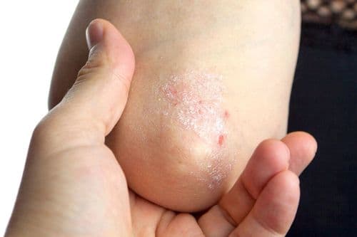 PEDS25: Pediatric Psoriasis: Emerging Oral Options: An Online Activity